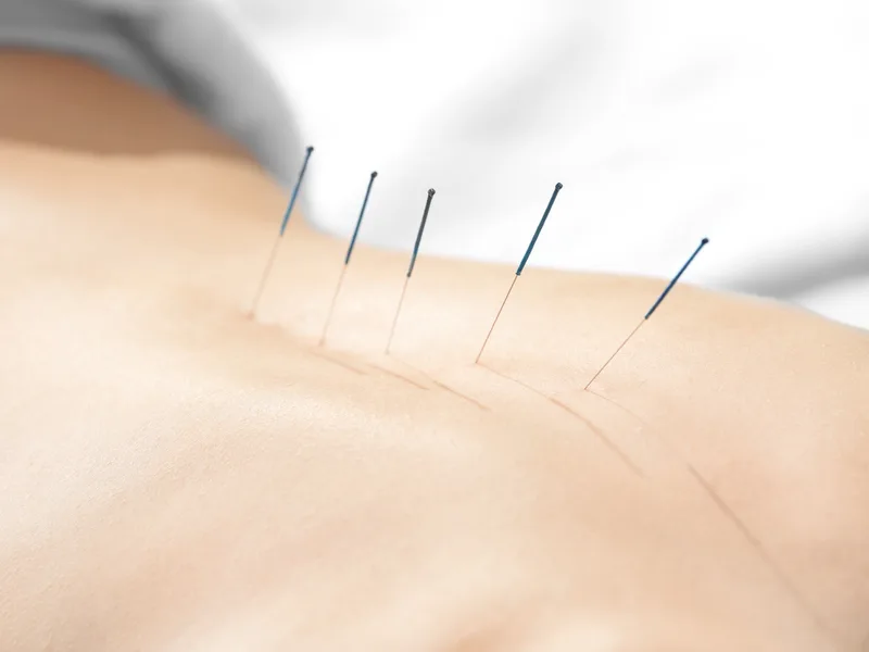 Acupuncture at Care Natural Wellness Center in Melbourne