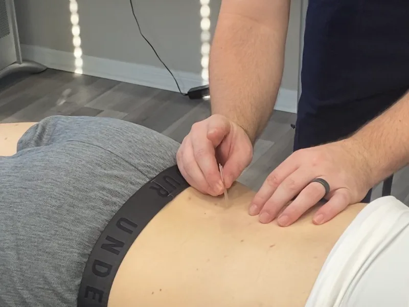 How Dry Needling works at Care Natural Wellness Center