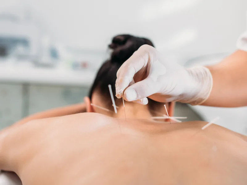 Dry Needling at Care Natural Wellness Center in Melbourne